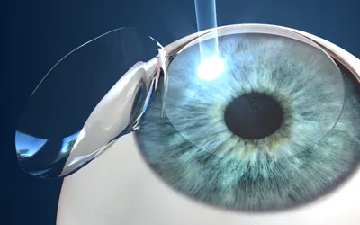 LASIK